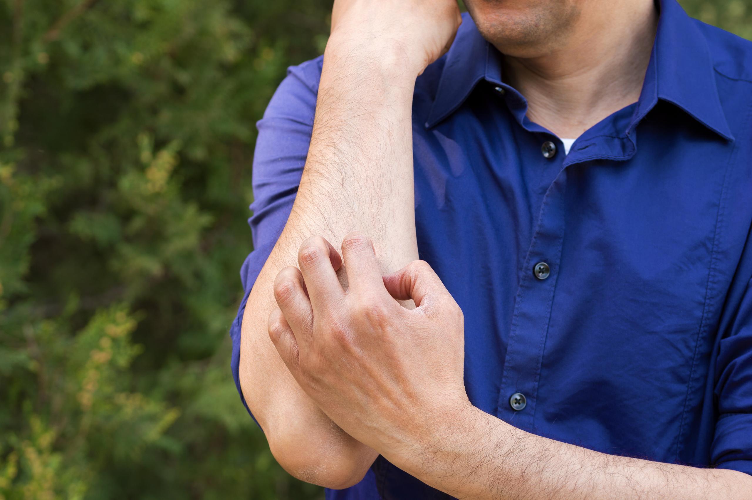 Poison Sumac Rash On Hands