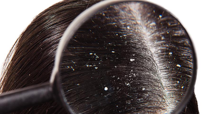 How Do I Know if I Have a Dry Scalp, Sensitive Skin, Dandruff, or