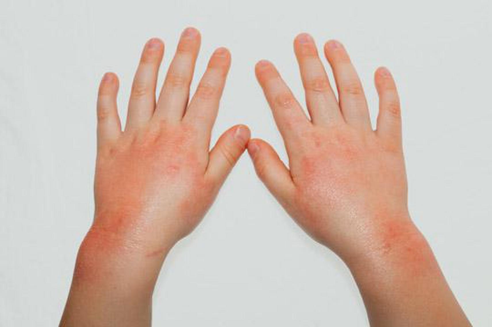 Tips To Help Treat Eczema In Winter Tips To Help Treat Eczema In Winter